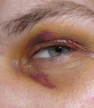 Charlie sitzt mit Blessuren in einer Selbsthilfegruppe und spricht über Gewalt