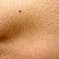 Hernien-Therapie: Von Nabel- bis Leistenbruch 