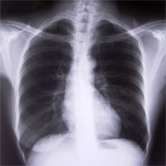 Erst OP an der Wirbelsäule, wenn alle konservativen Behandlungen ausgeschöpft sind